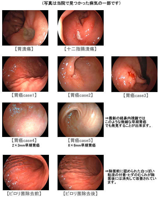 胃内視鏡（胃カメラ）で検査できる主な疾患